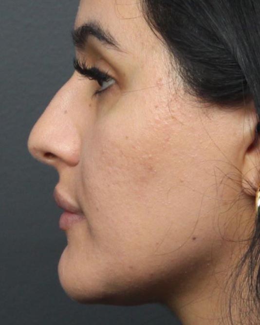 Rhinoplasty