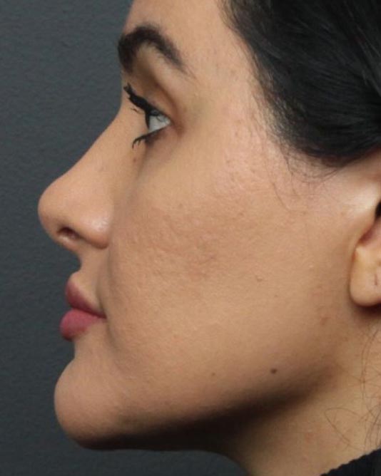 Rhinoplasty