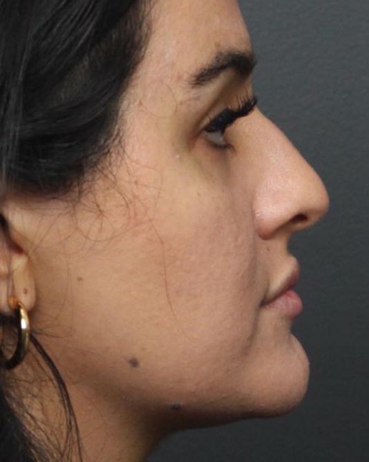 Rhinoplasty