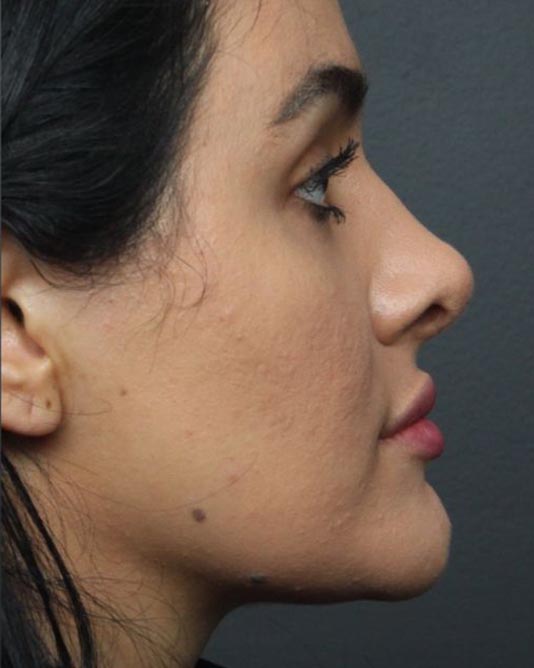 Rhinoplasty