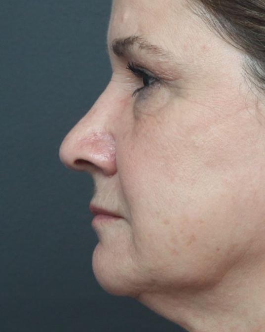 Rhinoplasty