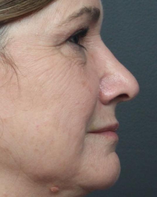 Rhinoplasty