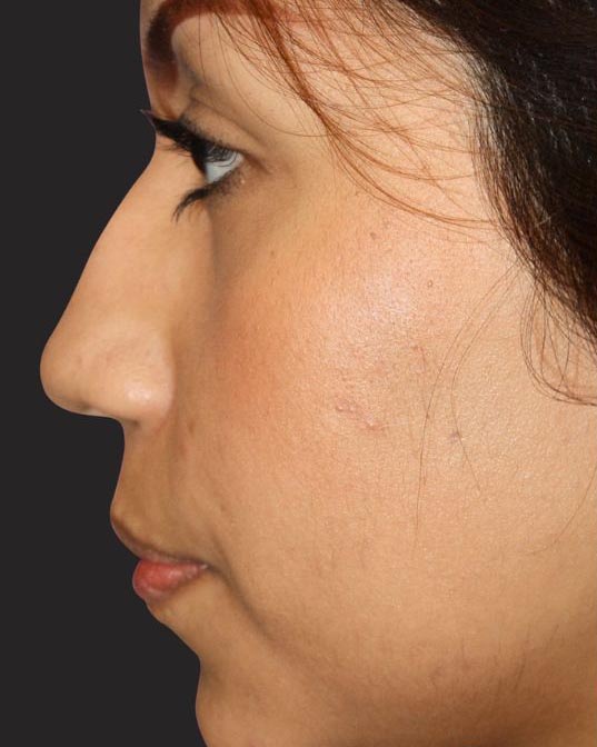 Rhinoplasty