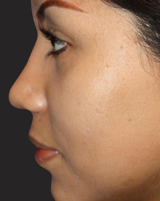 Rhinoplasty