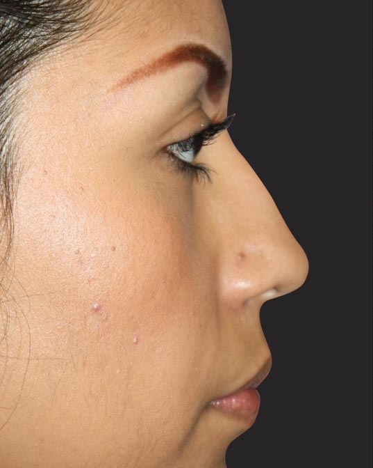 Rhinoplasty