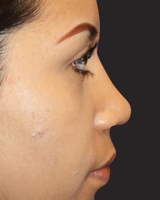 Rhinoplasty