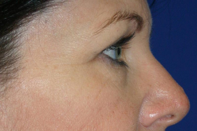 Lower Eyelid Surgery