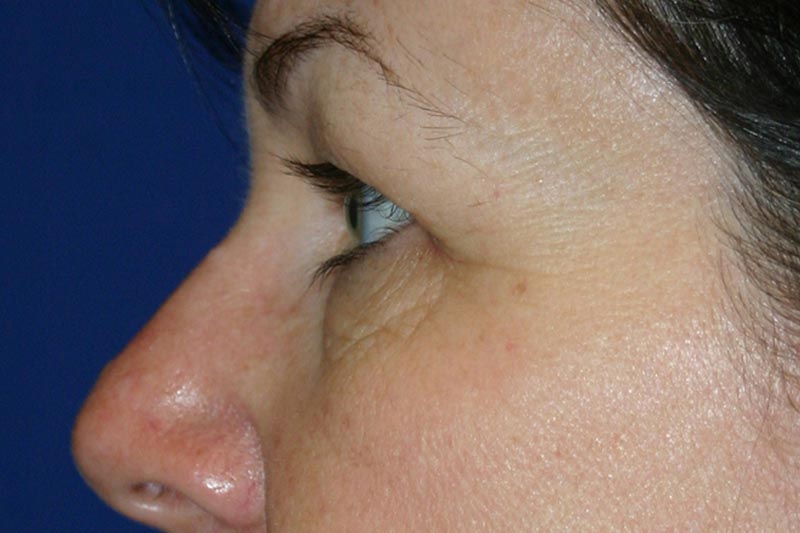 Lower Eyelid Surgery