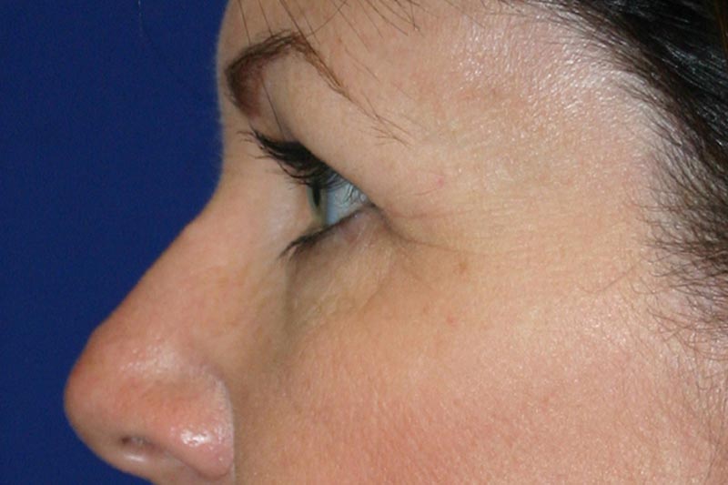 Lower Eyelid Surgery