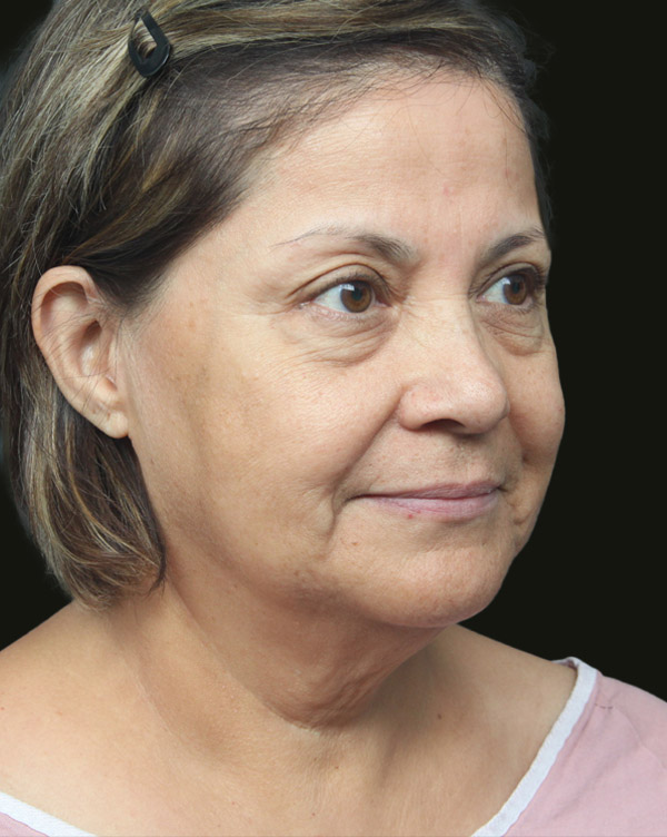 Facelift