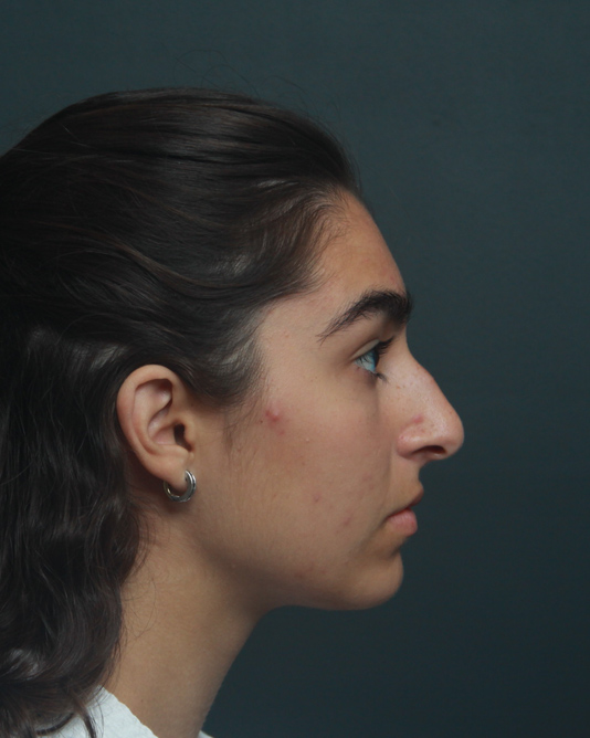 Rhinoplasty