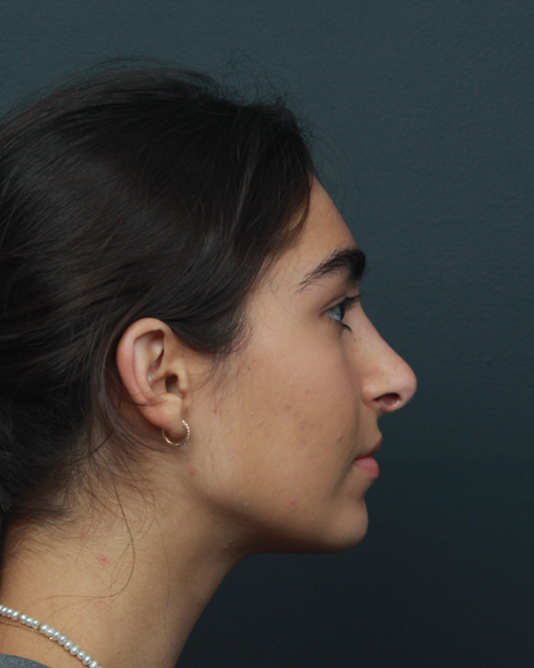 Rhinoplasty