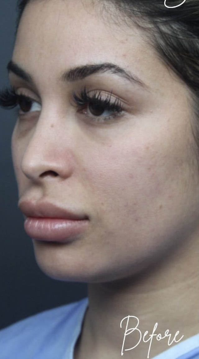 Neck Liposuction
