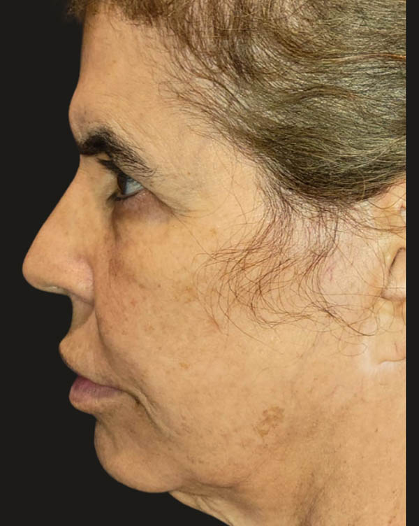 Facelift