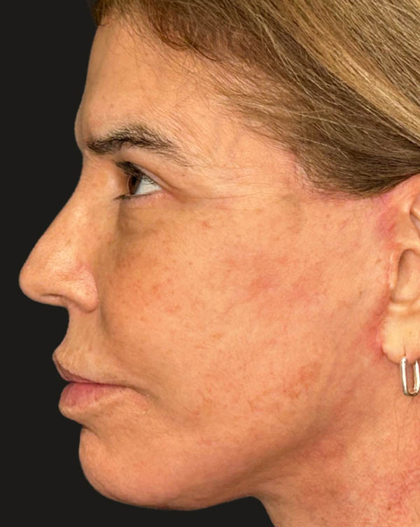 Facelift