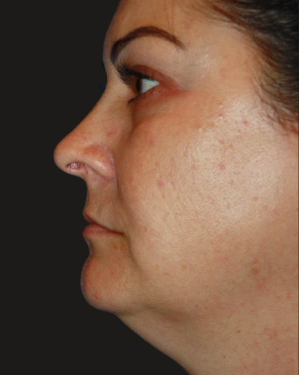 Facelift