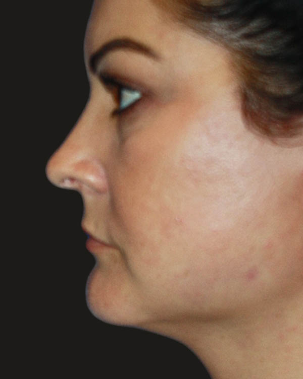 Facelift